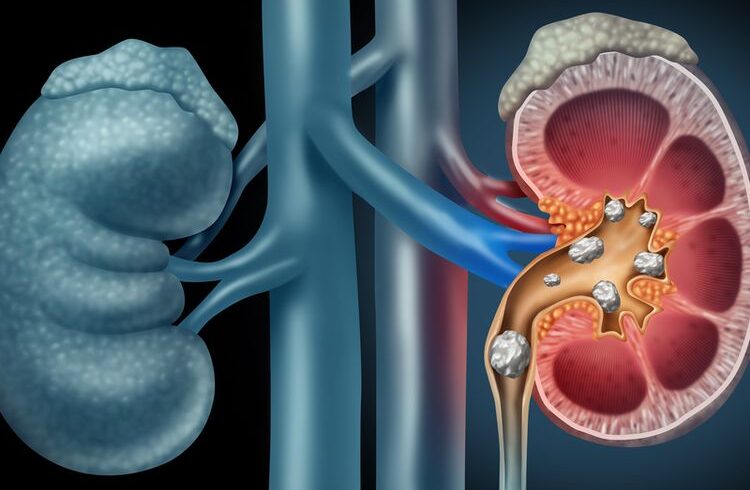 Pengobatan Batu Ginjal: Mengatasi Masalah Kesehatan dengan Bijak